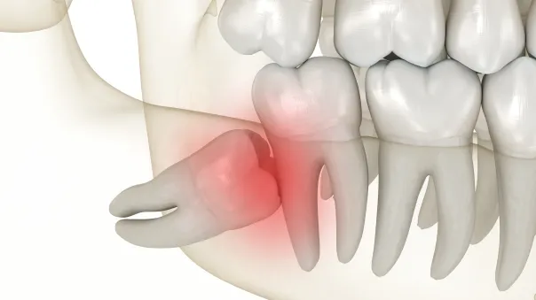 L’extraction des dents de sagesse au cabinet dentaire du docteur Sandreschi.