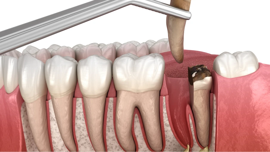 Extraction simple au cabinet du Docteur Frédéric Sandreschi