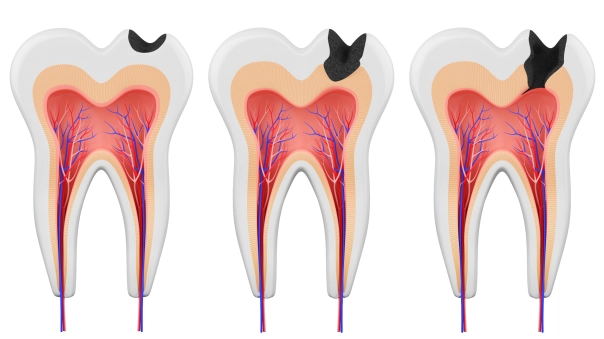 Le traitement des caries au cabinet dentaire du Dr Sandreschi.